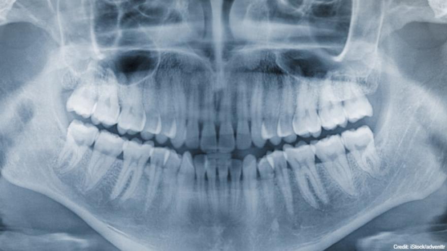 AC1Fv-1608151705-181911-blog-xray teeth dentist credit iStock and adventtr